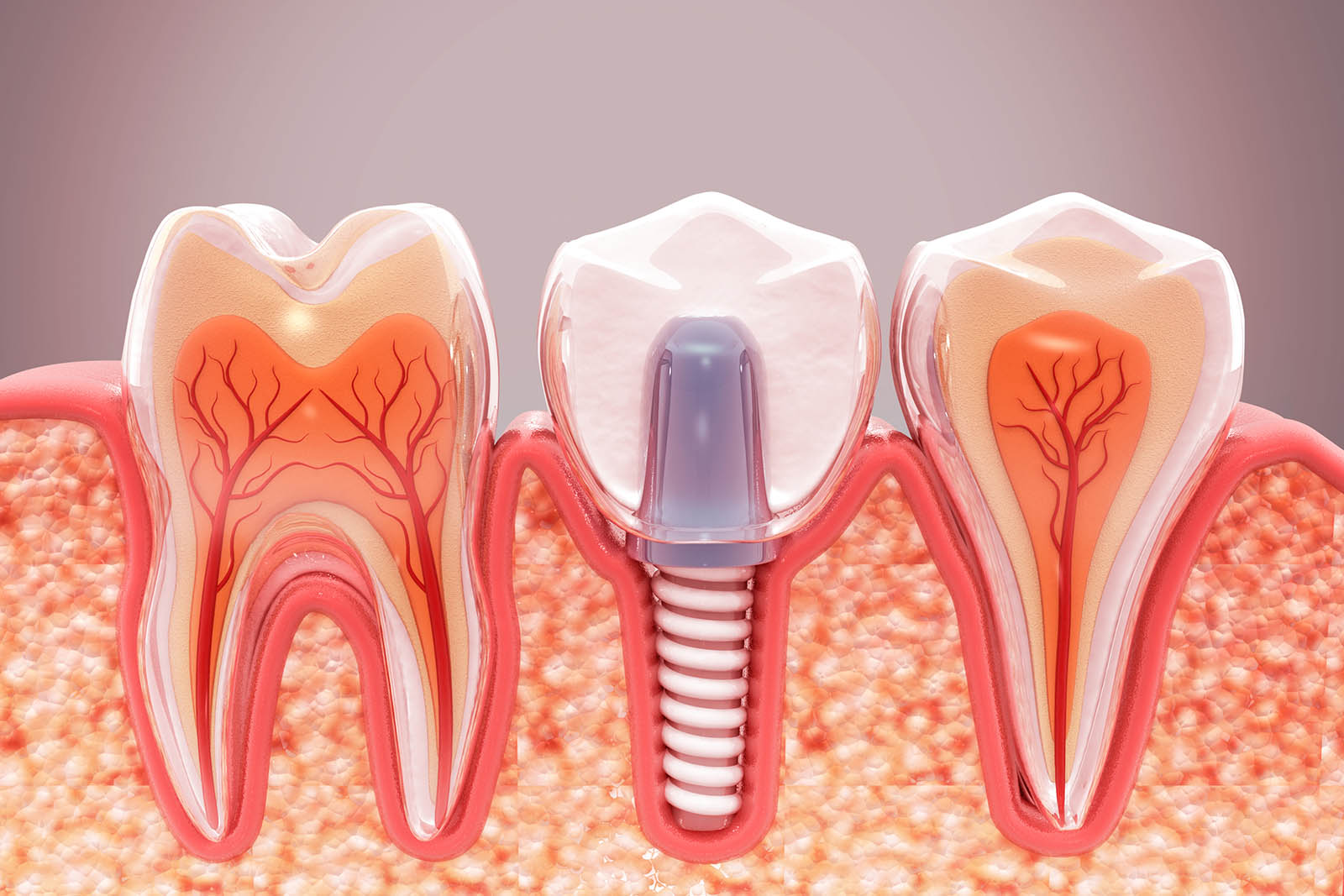 Dental Implants: A Superior Alternative For Bone Health