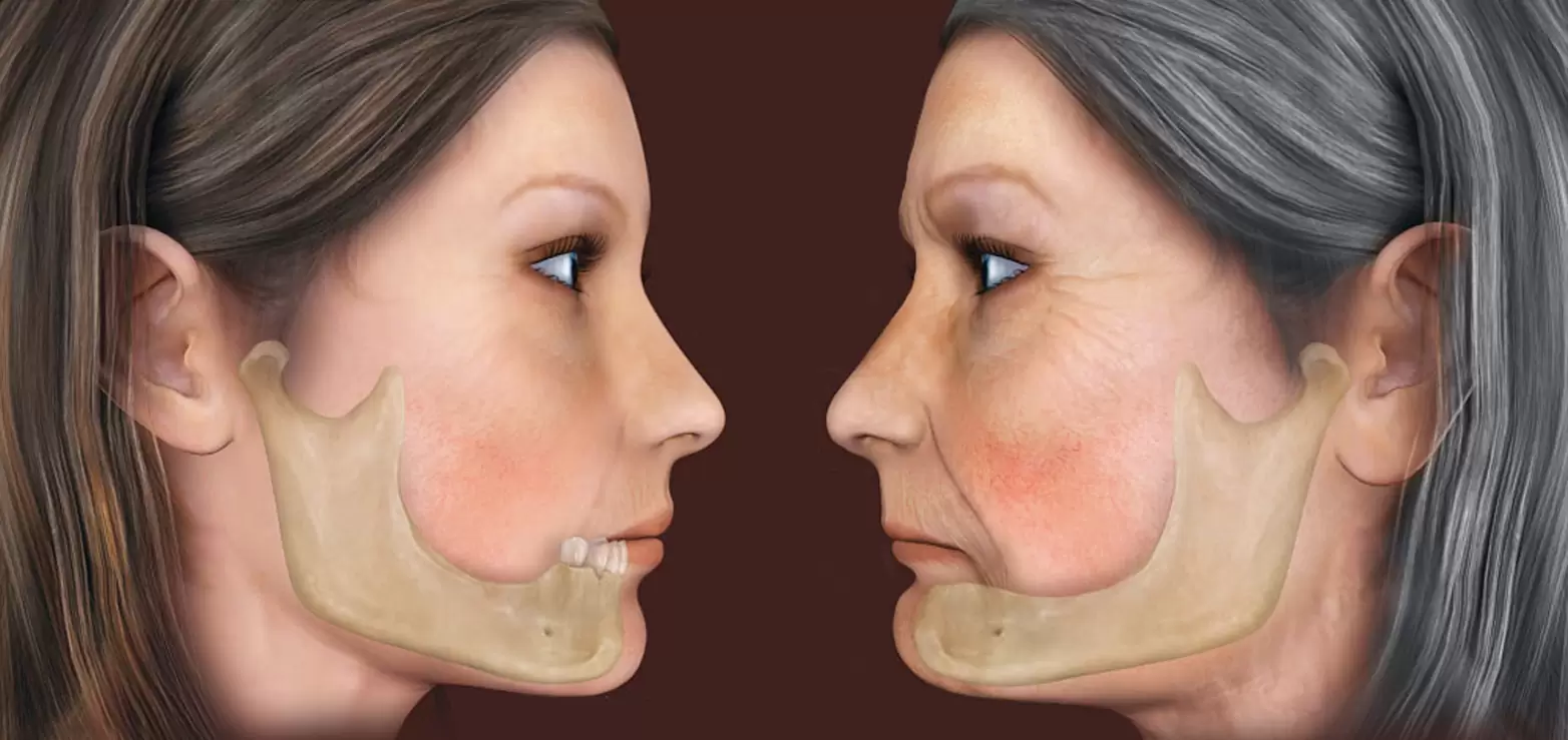 Facial Collapse Is A Real Risk With Missing Teeth