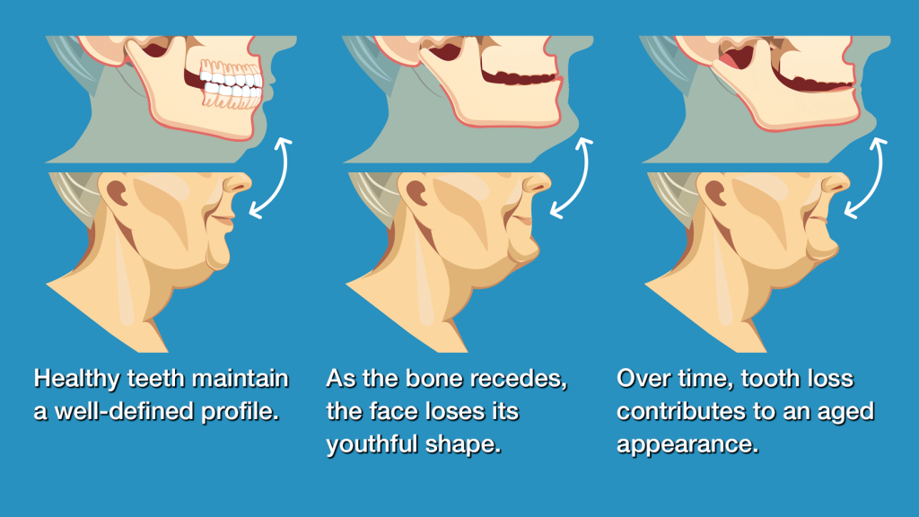 How Does Tooth Loss Affect Face Shape?