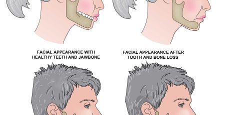 How Missing Teeth Affect Your Face Shape and Jawline