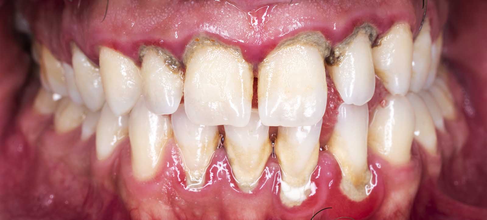 Gum Disease As A Gateway To Sepsis