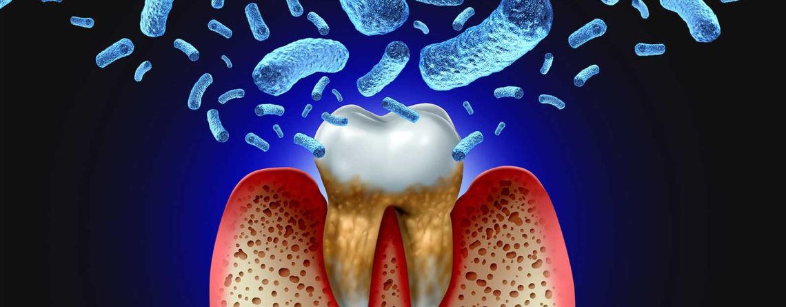 Sepsis From Tooth Decay And Gum Disease