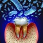 Sepsis from Tooth Decay and Gum Disease