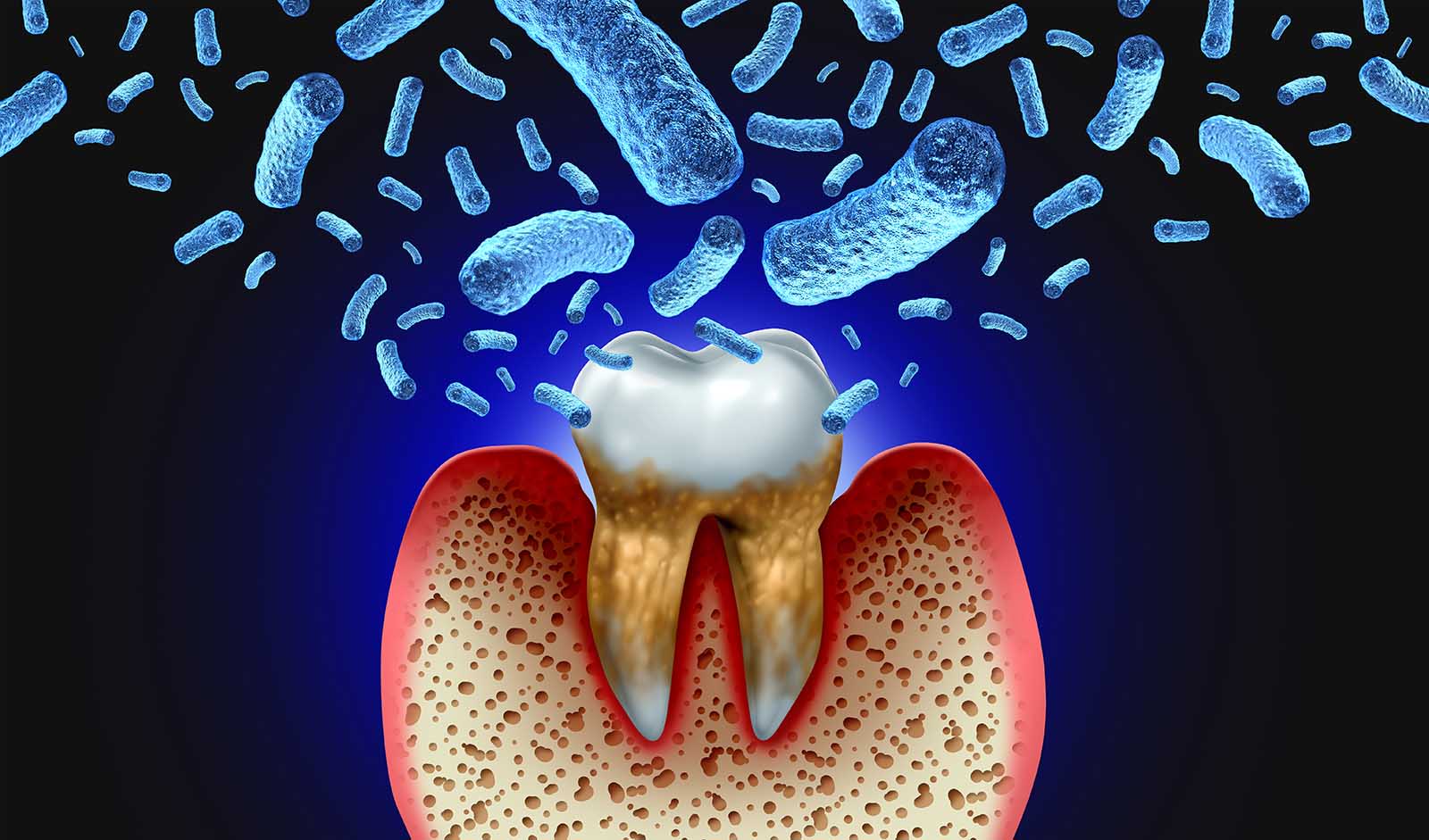 Sepsis From Decay & Gum Disease - 6 Symptoms Of Sepsis