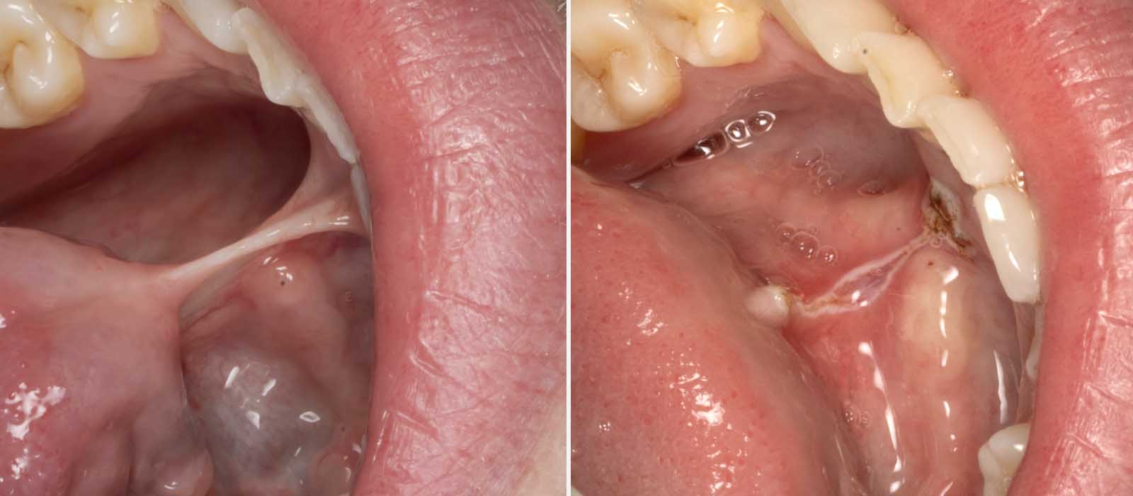 Gold Coast Frenectomy Tongue-Tie Removal Dentist Near Me