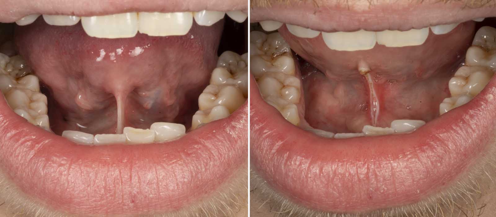 Gold Coast Dentist For Frenectomy Tongue Tie Removal