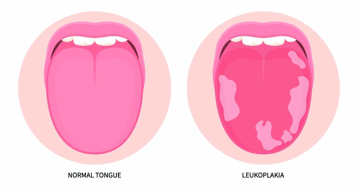 Risks And Symptoms Of Leukoplakia