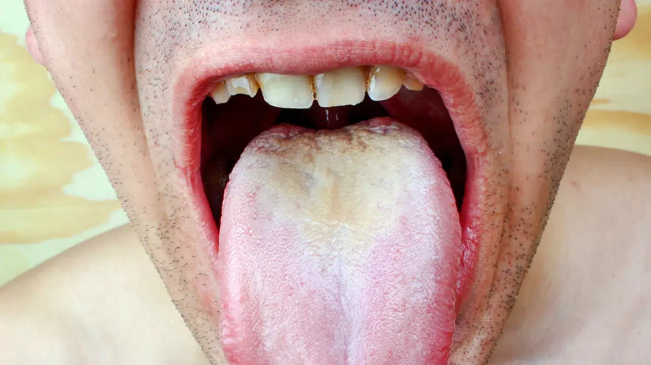 Brushing Your Tongue Removes Bacteria And Toxins