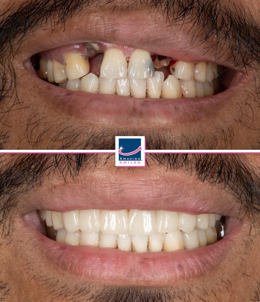 smile makeover gold coast dentist