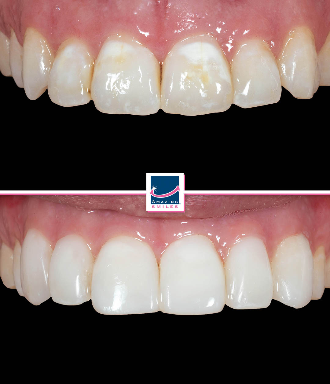 Treating Fluorosis Composite Veneers Gold Coast