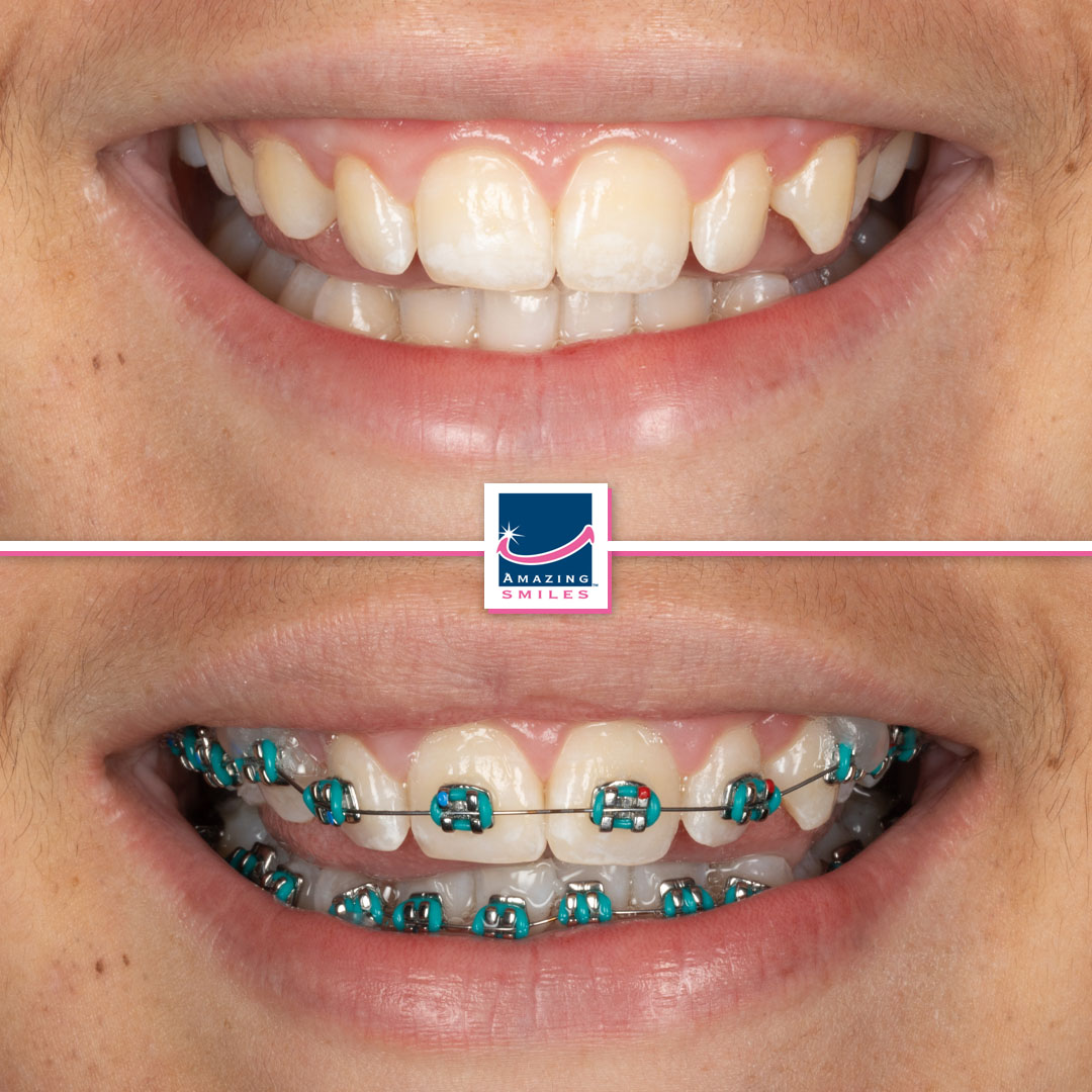 orthodontics jimboomba