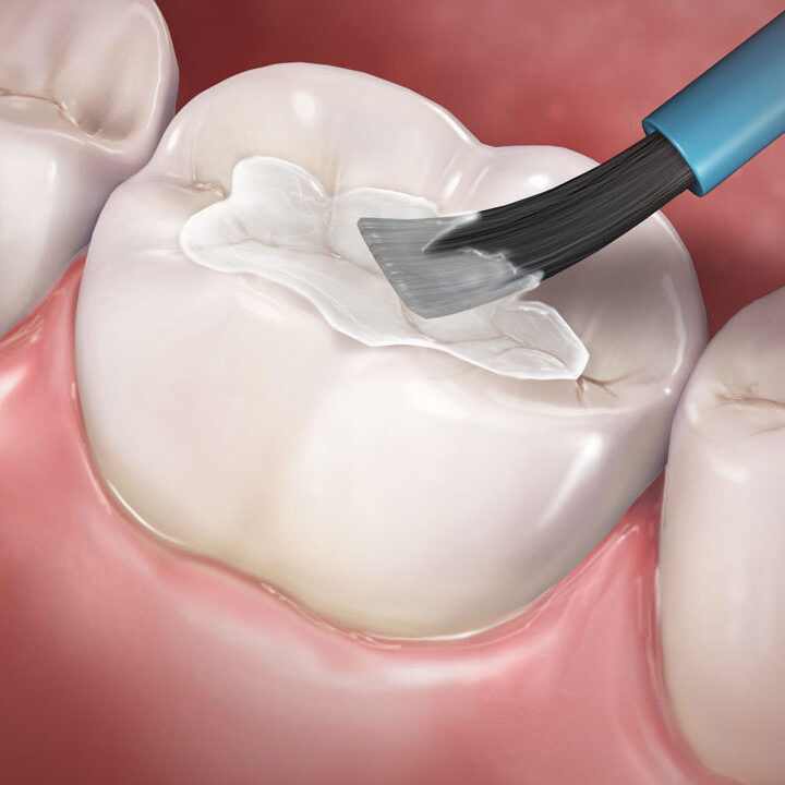 Fissure Sealants