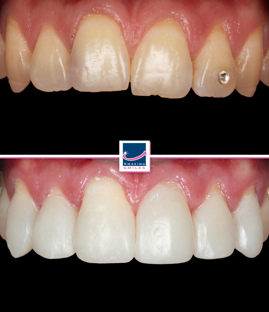 Composite Veneers Logan