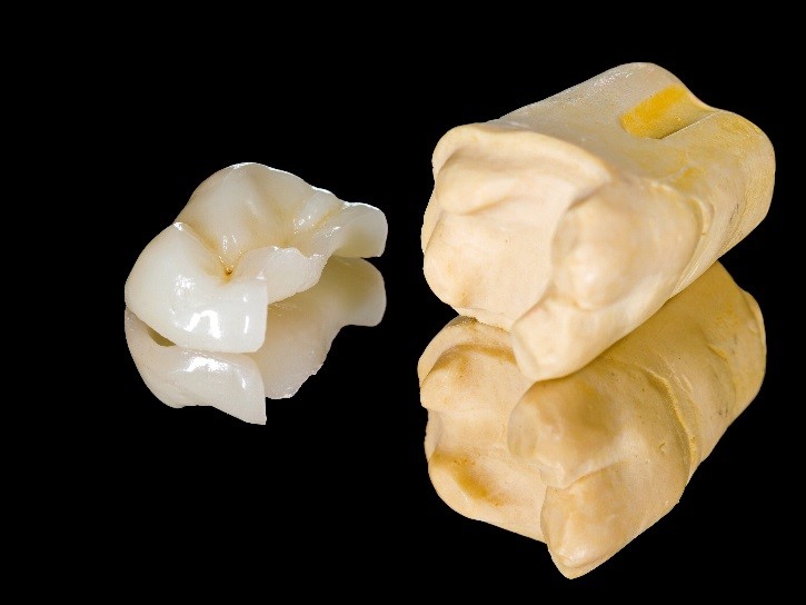 Dental Inlays And Onlays