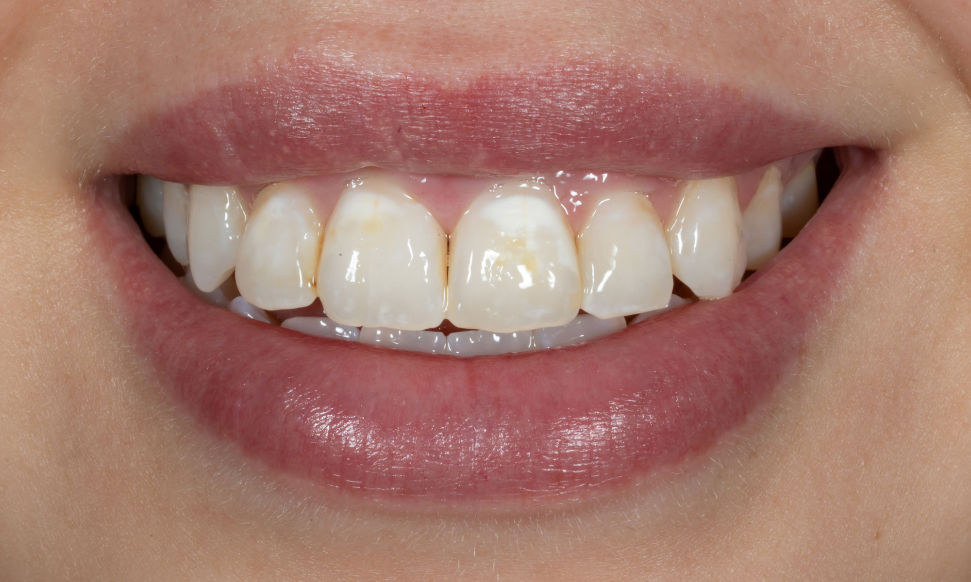 Composite Veneers Wynnum