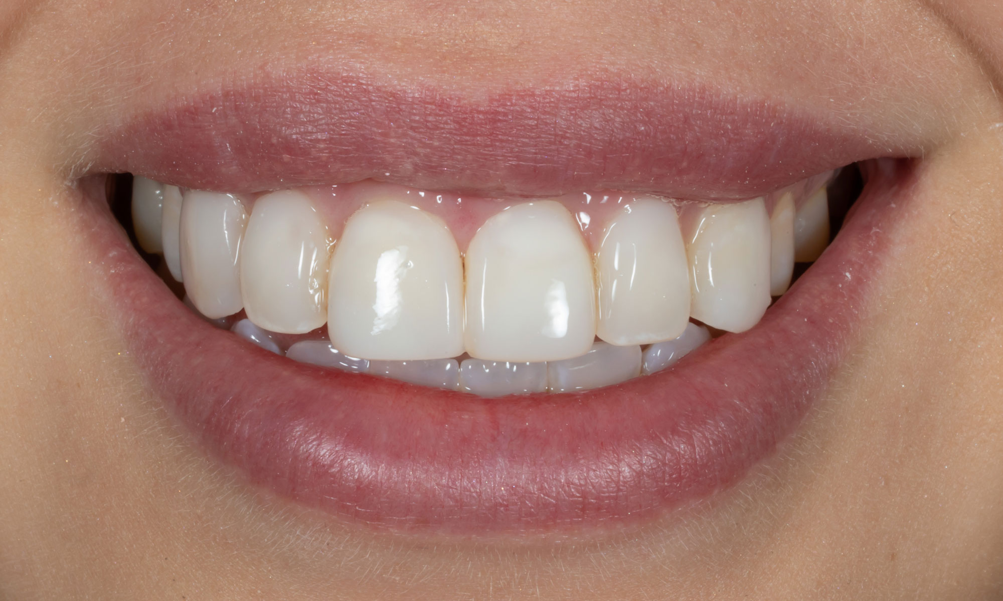 Composite Veneers Wynnum