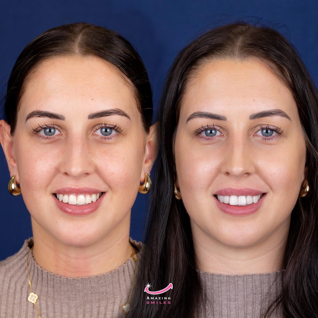 Smile Makeover Dentist Gold Coast