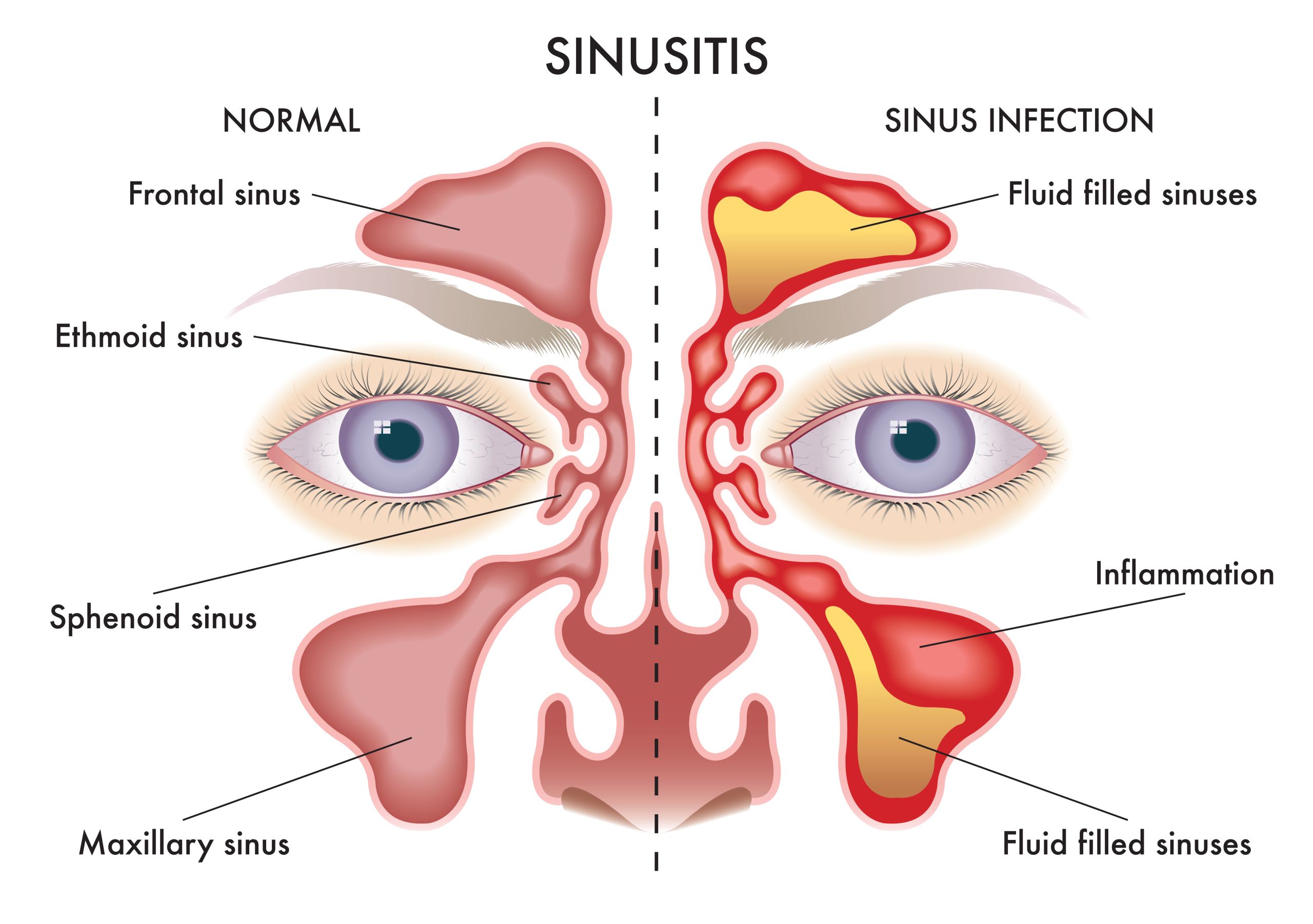 What Is Sinusitis?