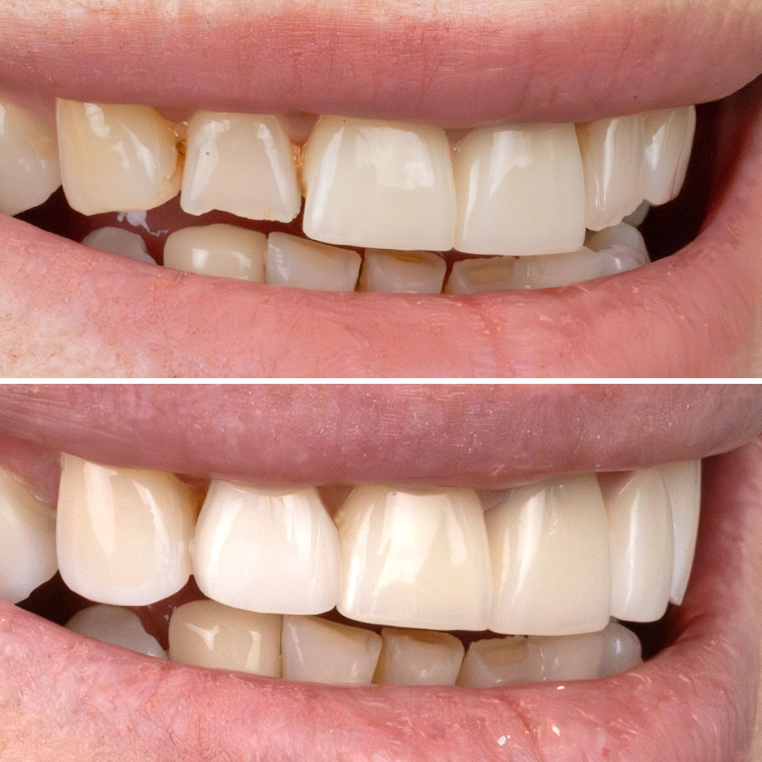 Composite Bonding
