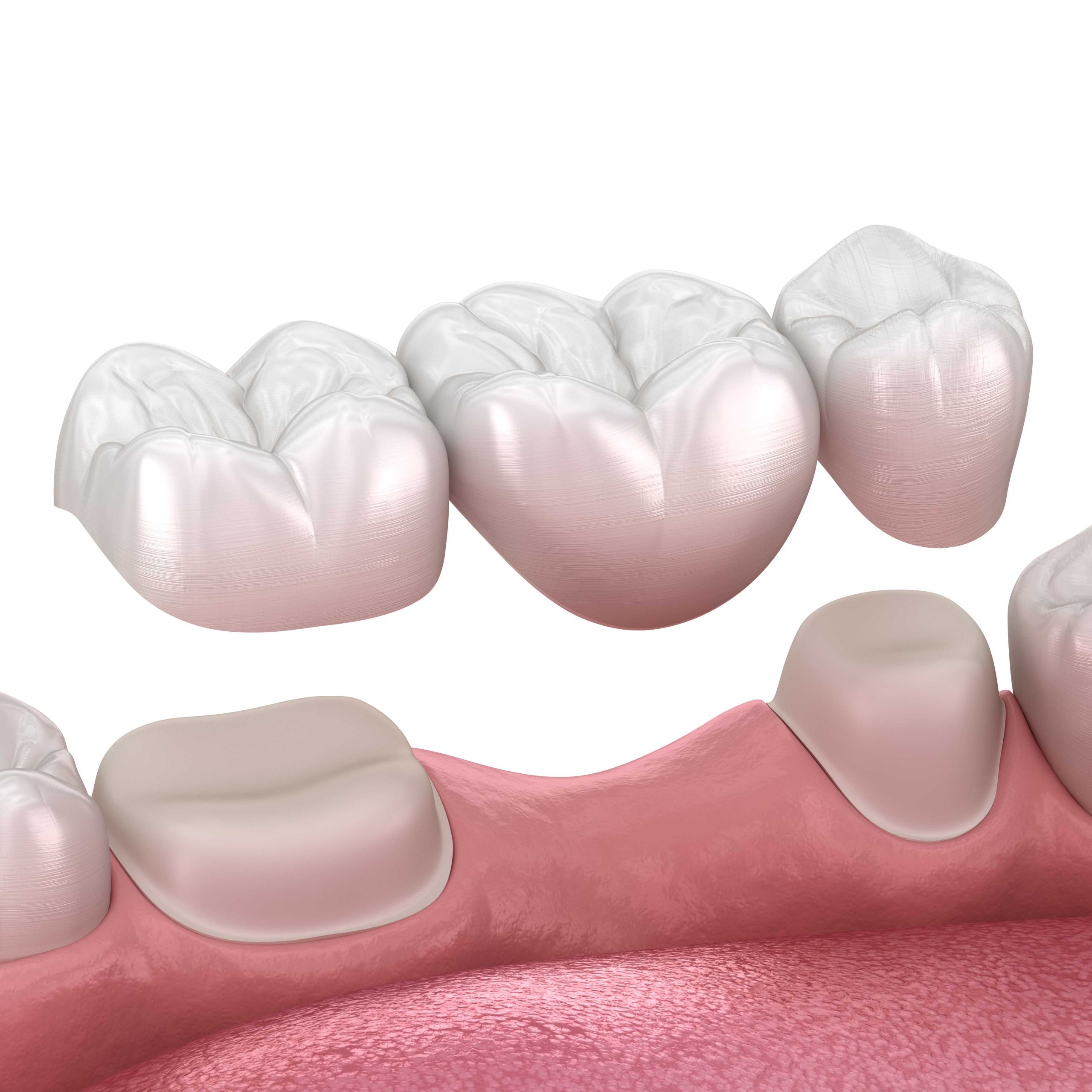 dental bridge cosmetic dentist gold coast