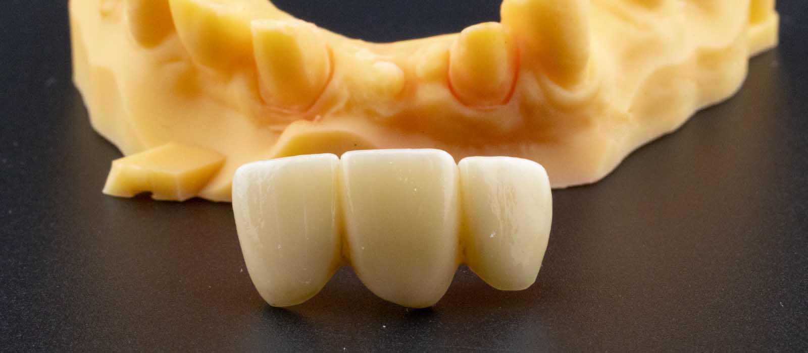 Dental Bridge Dentist Gold Coast