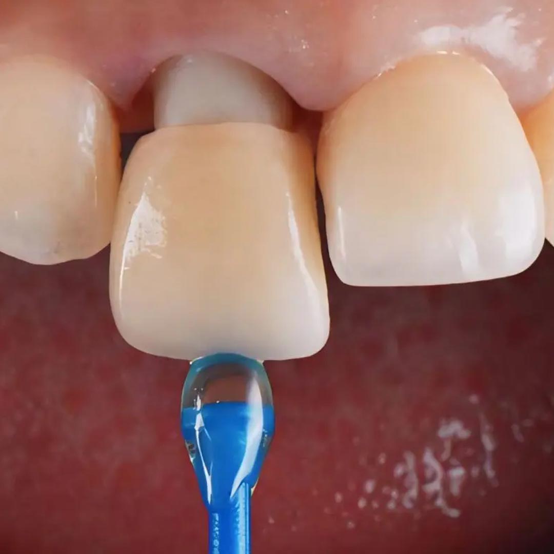Dental Crowns To Treat Bruxism Damaged Teeth