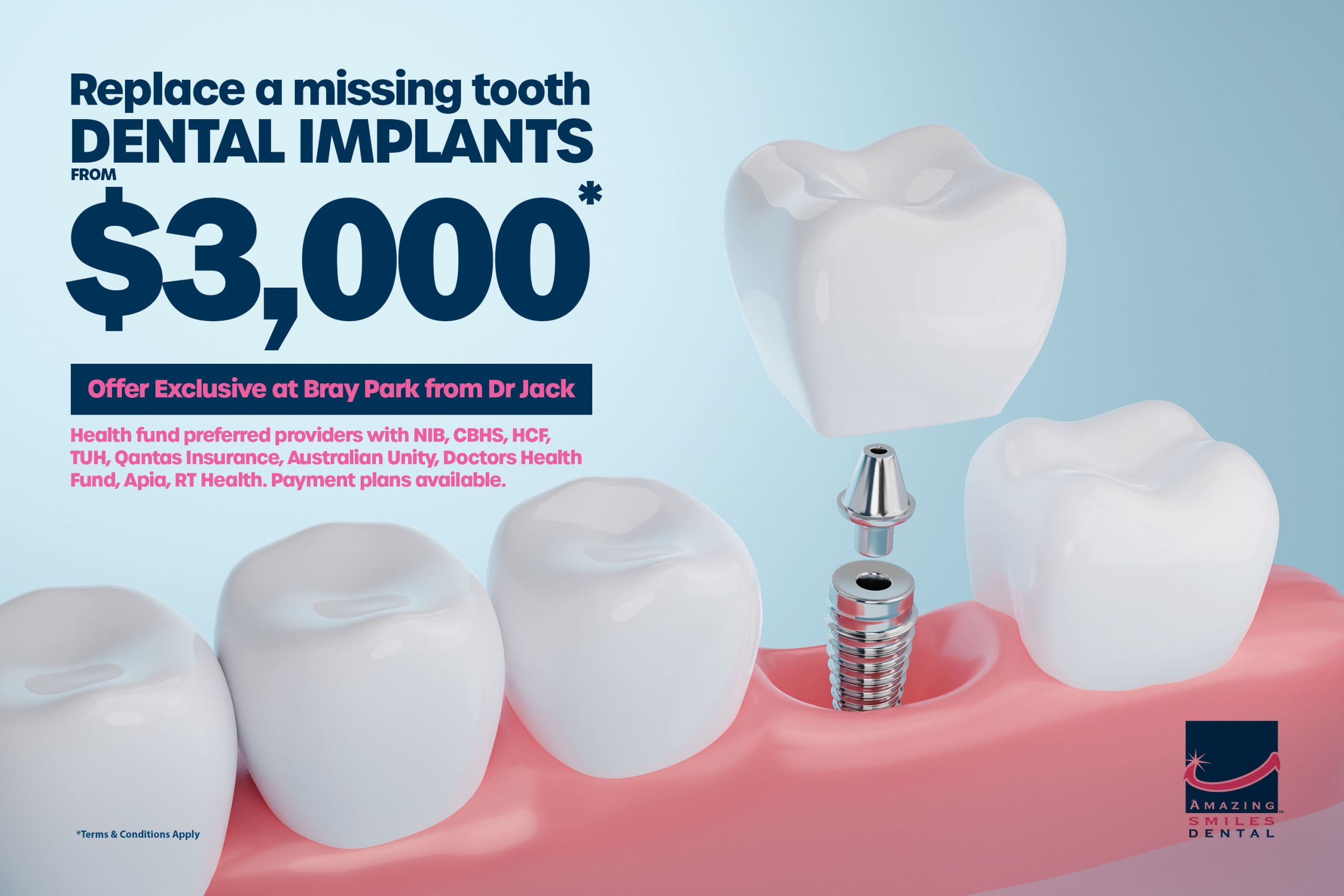 Dental Implant Bray Park