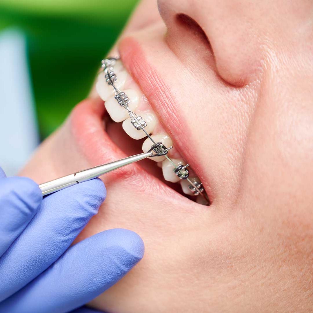 Orthodontic Treatment To Fix Damaged Teeth From Bruxism