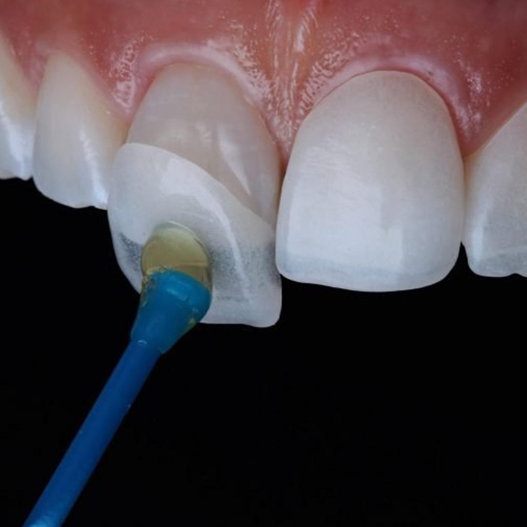 Porcelain Veneers To Treat Bruxism Damaged Teeth