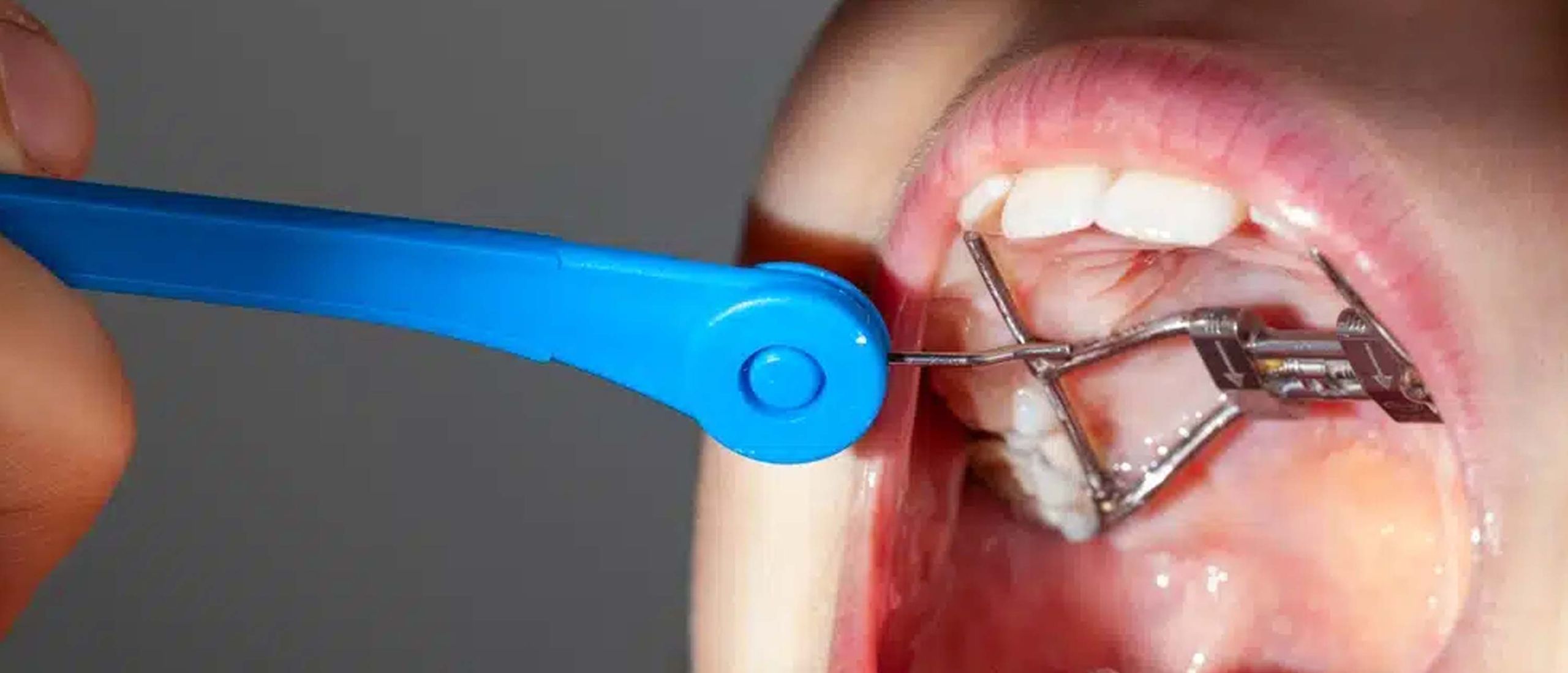 Palate Expander