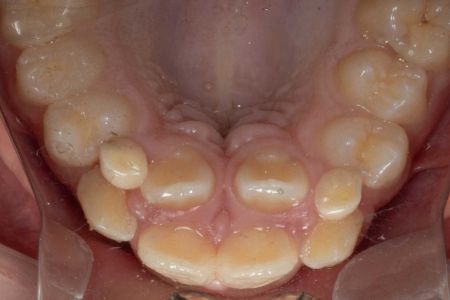 Shark Teeth in Children