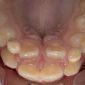 Shark Teeth in Children