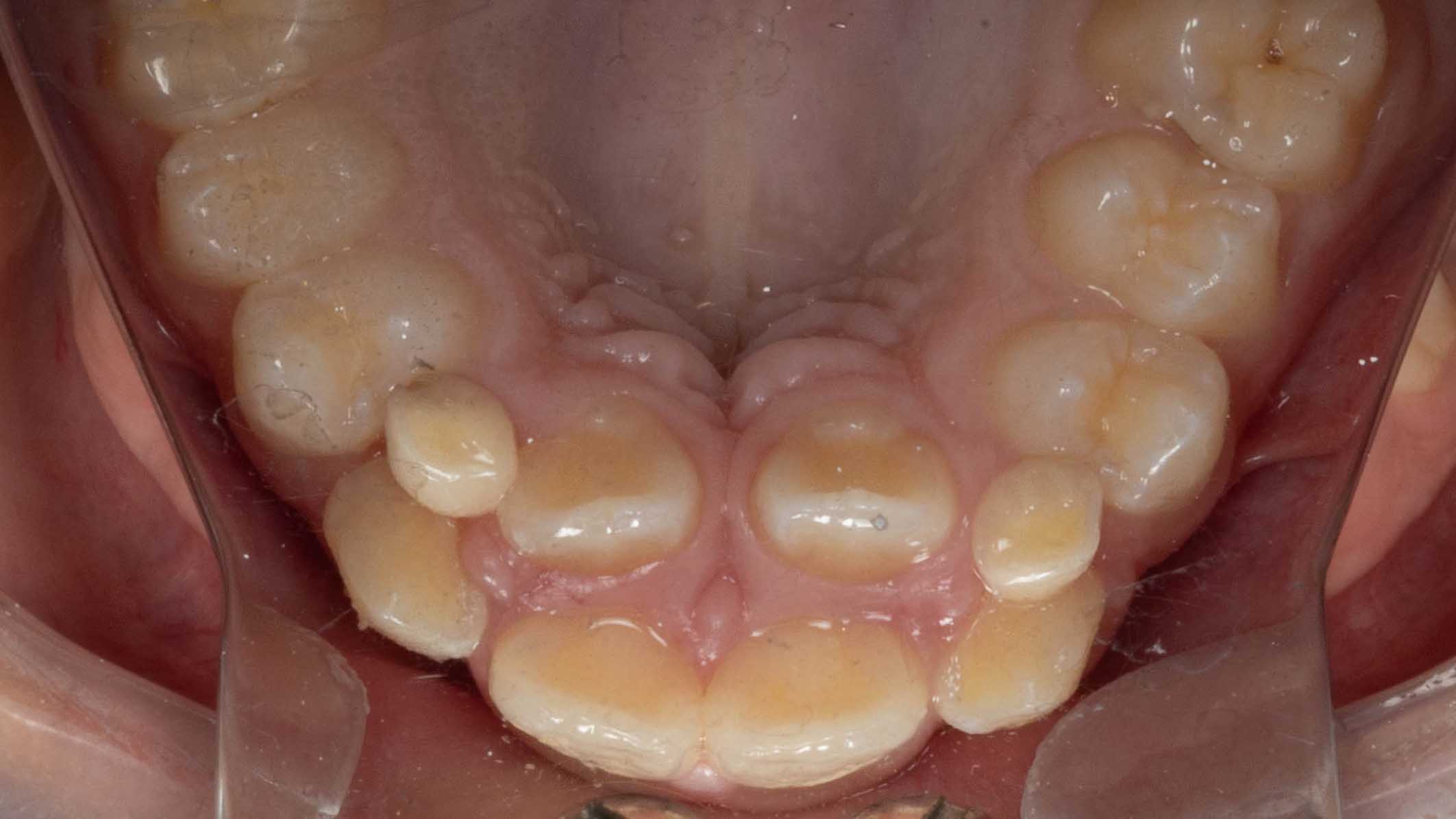 Shark Teeth in Children