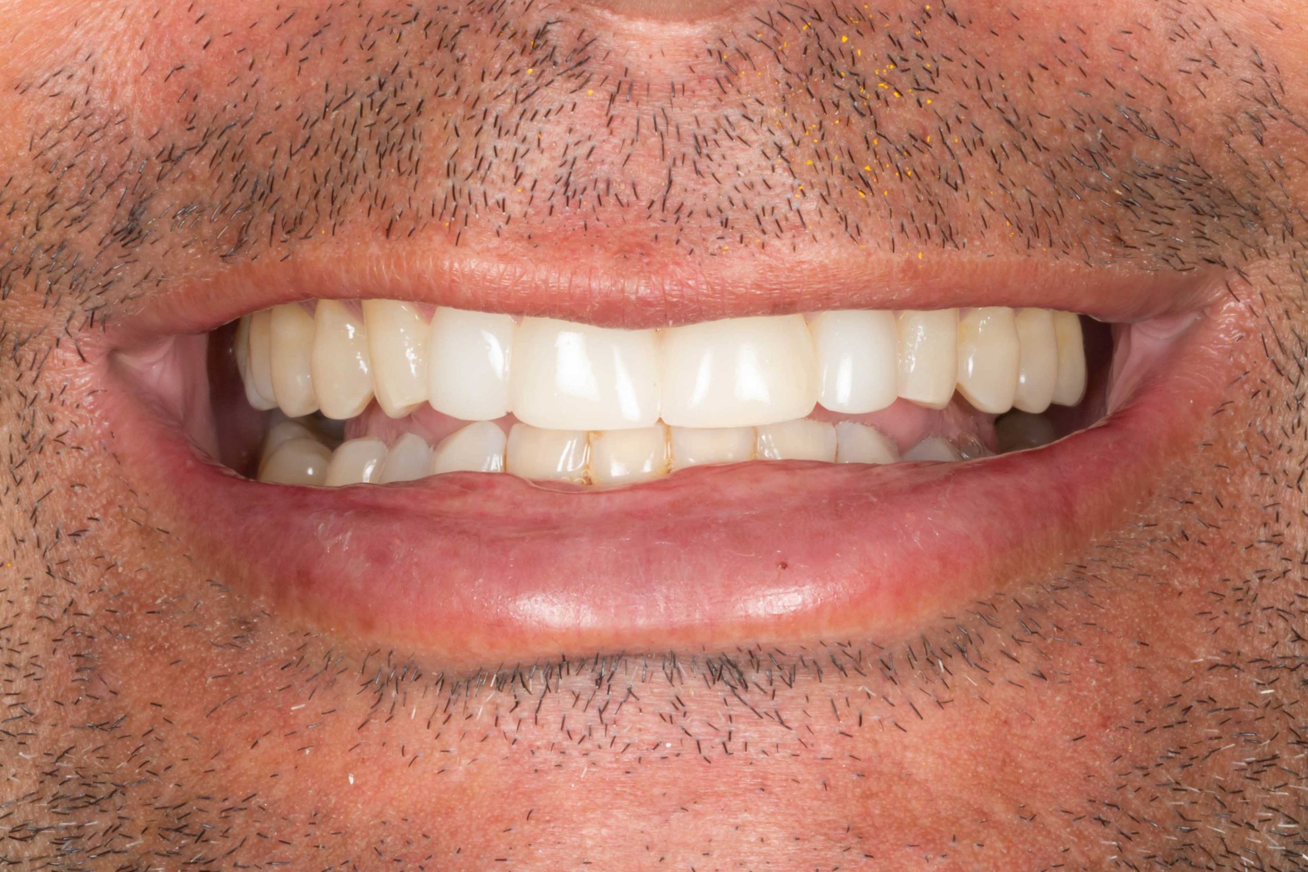 composite veneers after