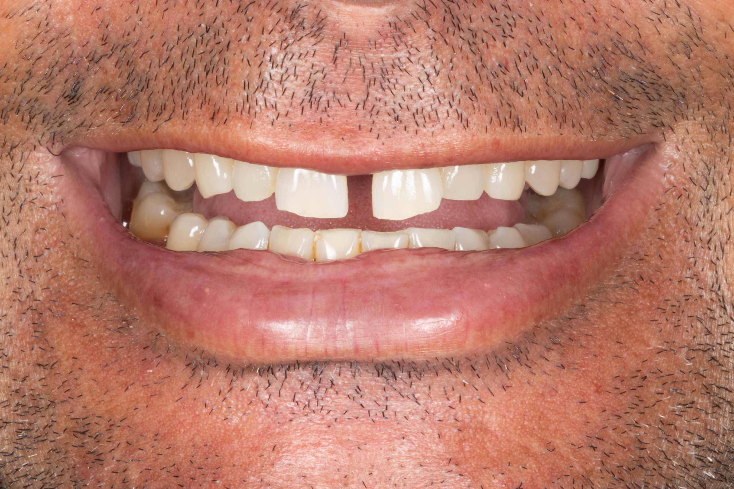 composite veneers before