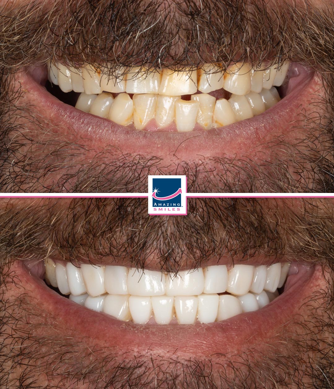 cosmetic dentist composite veneers