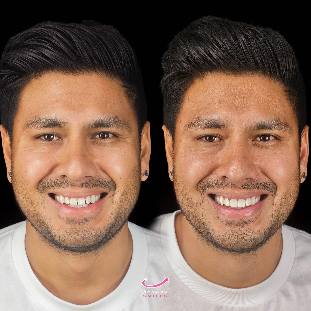 cosmetic dentist for composite veneers near me