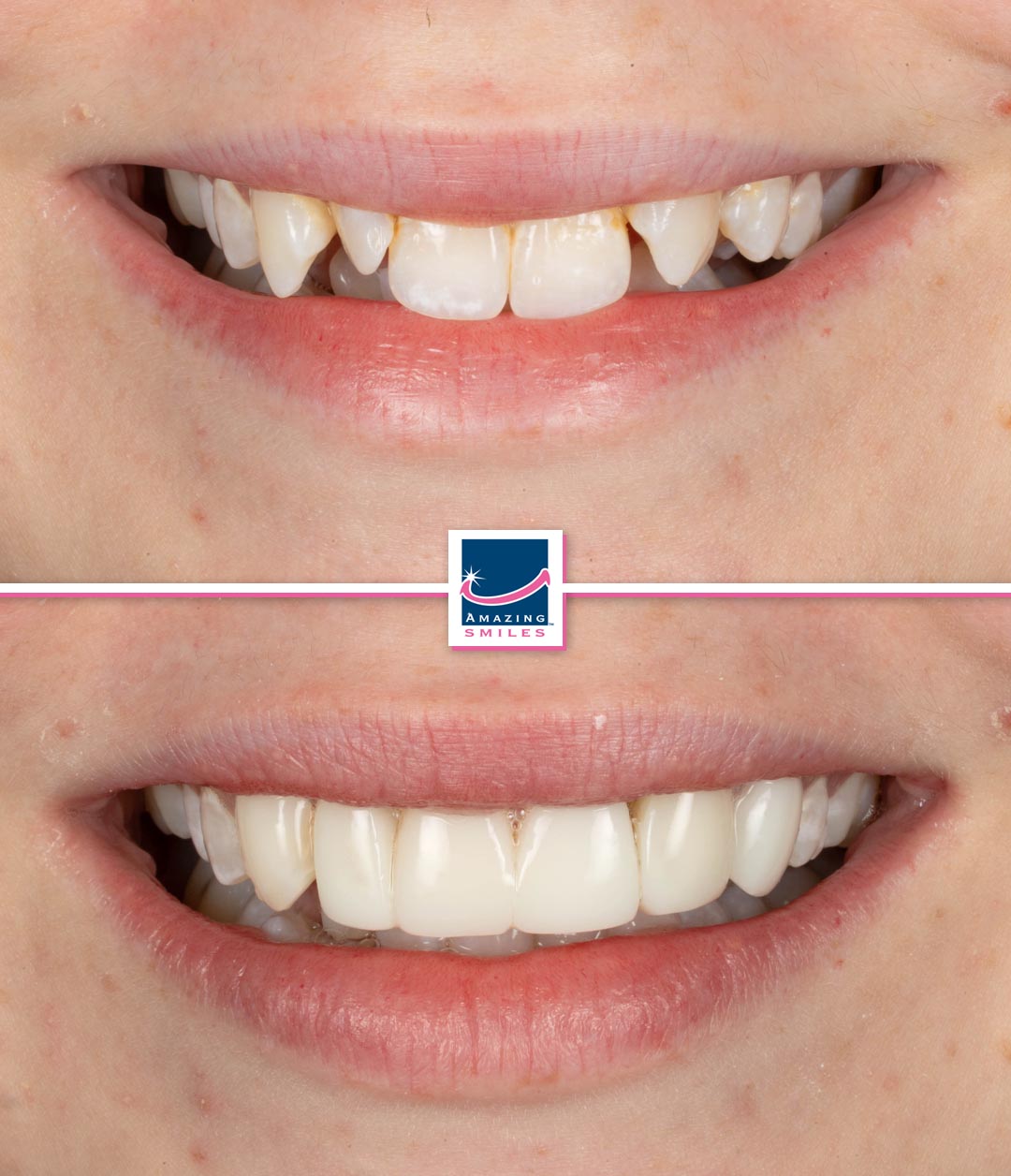 dentist smile makeover composite veneers