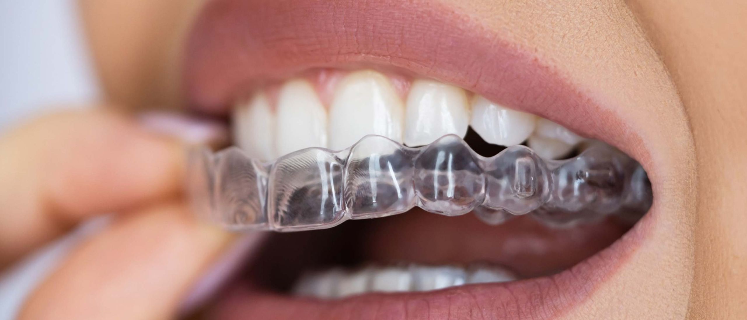 invisible braces gold coast orthodontics