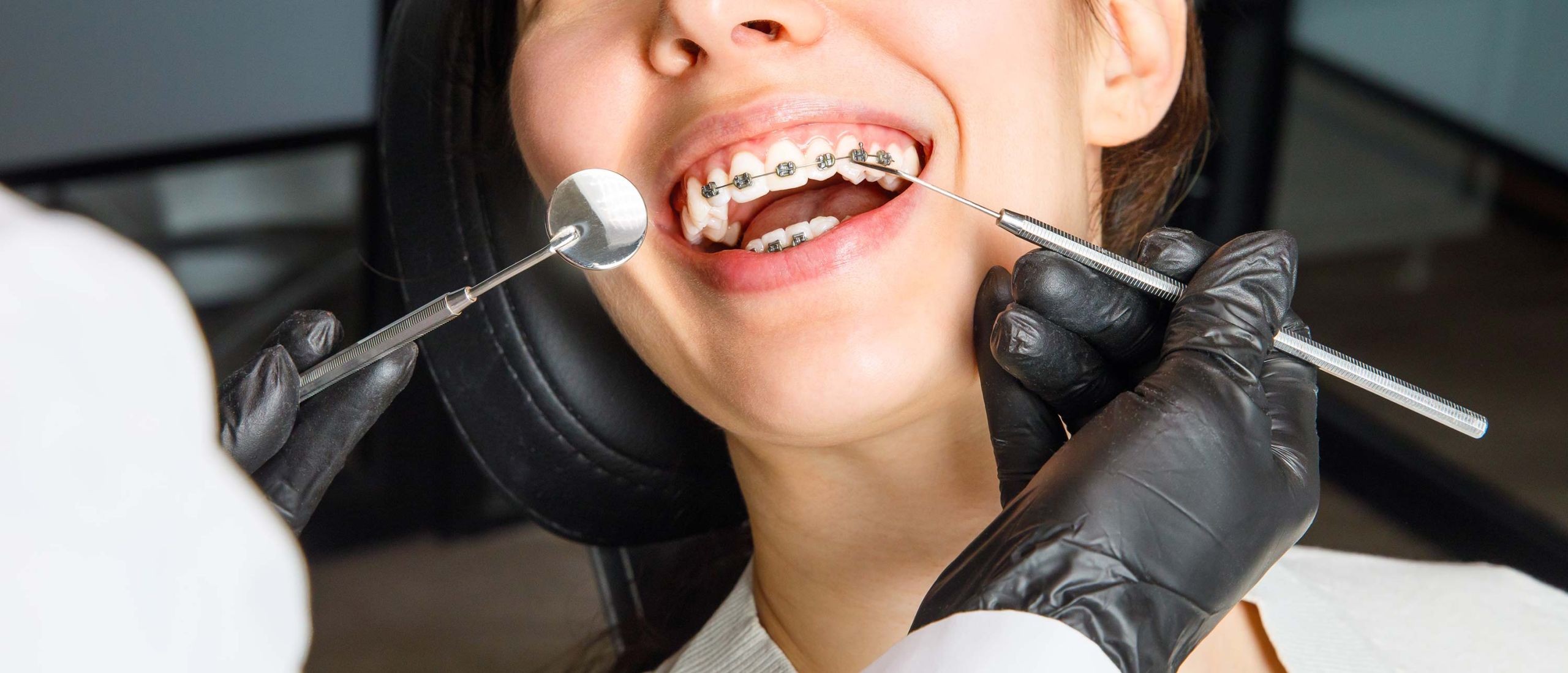metal braces orthodontics gold coast