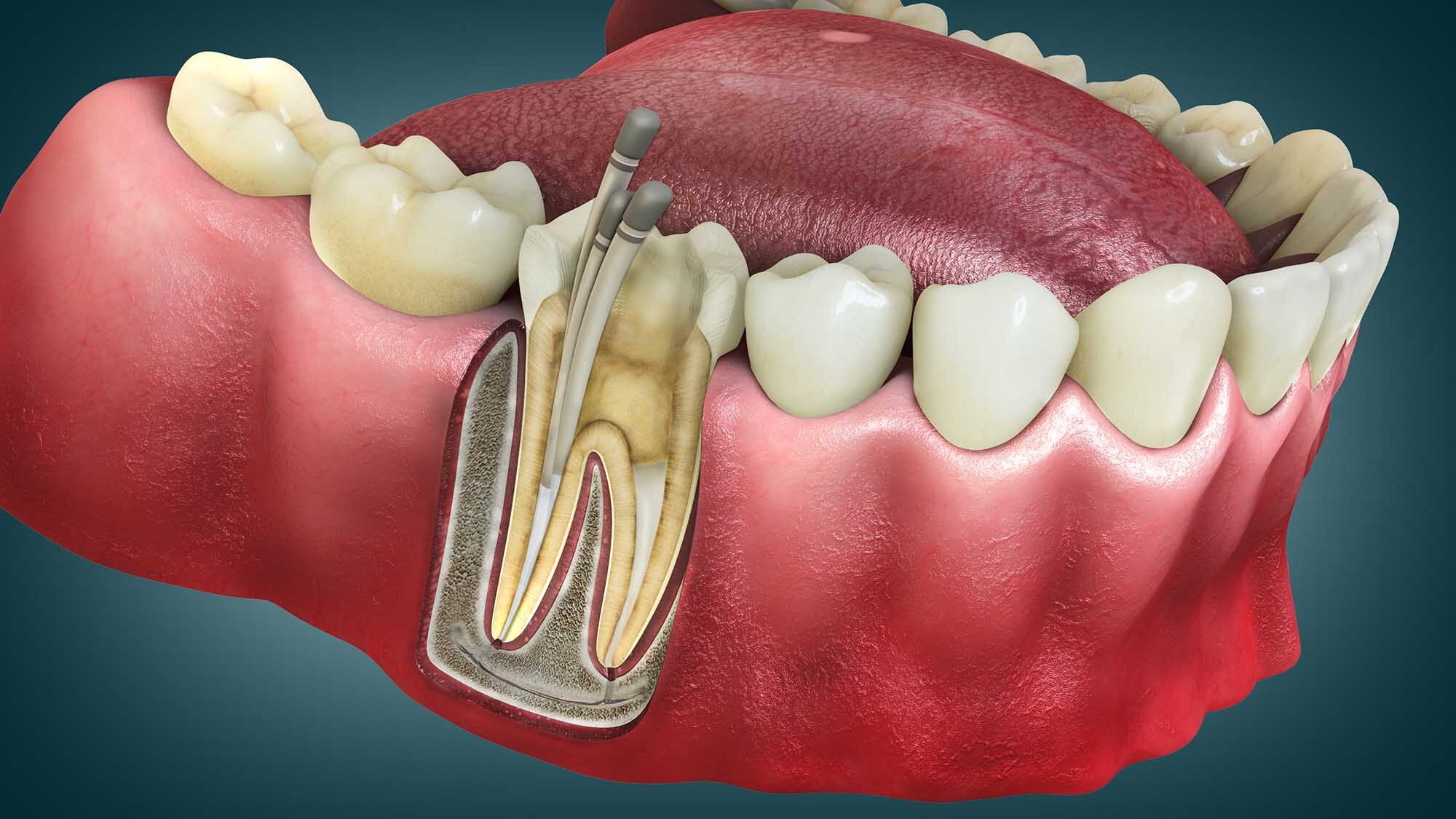 Root Canal Therapy - Dentist Gold Coast Root canal therapy - dentist gold coast