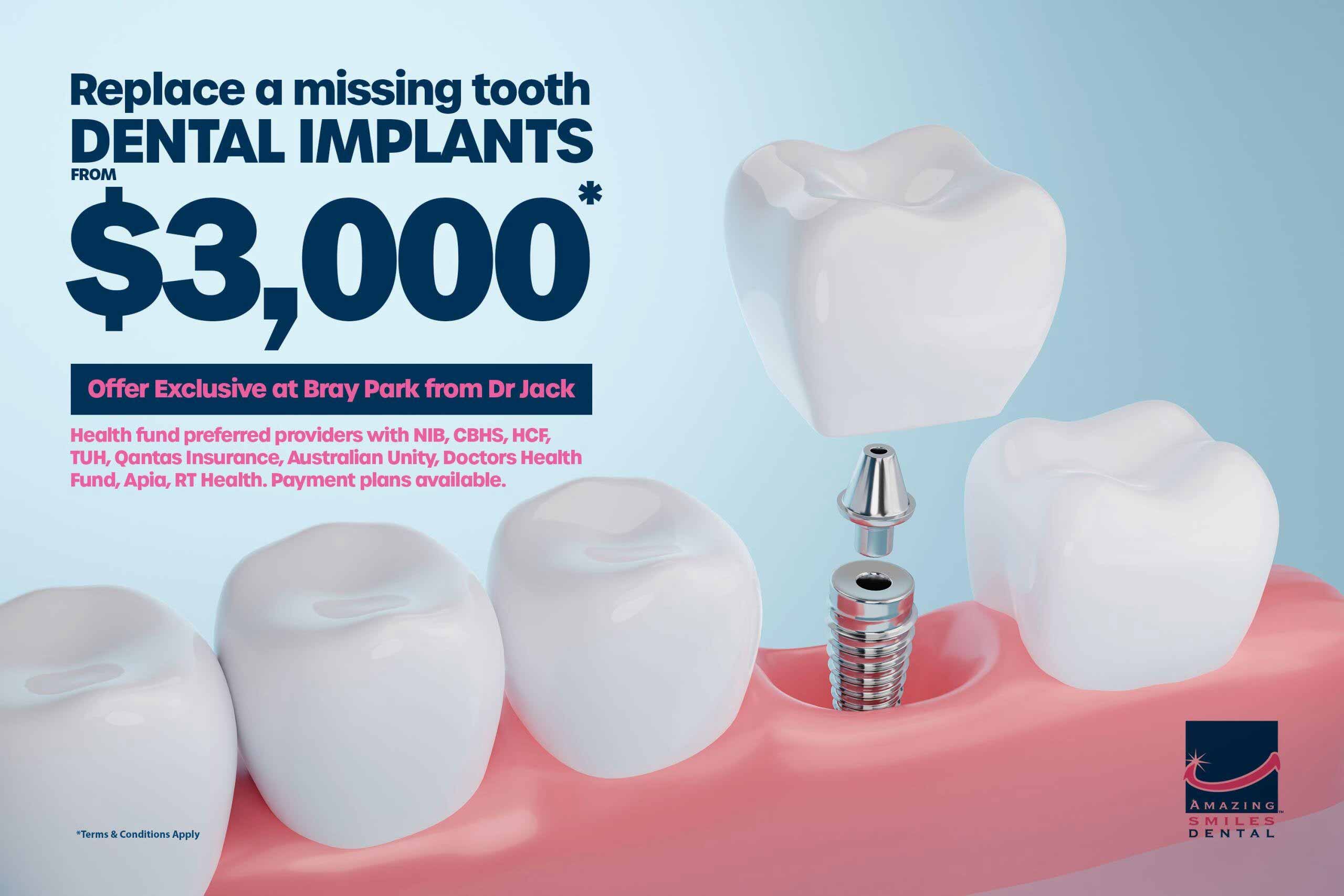 Cheap Dental Implants Cheap dental implants