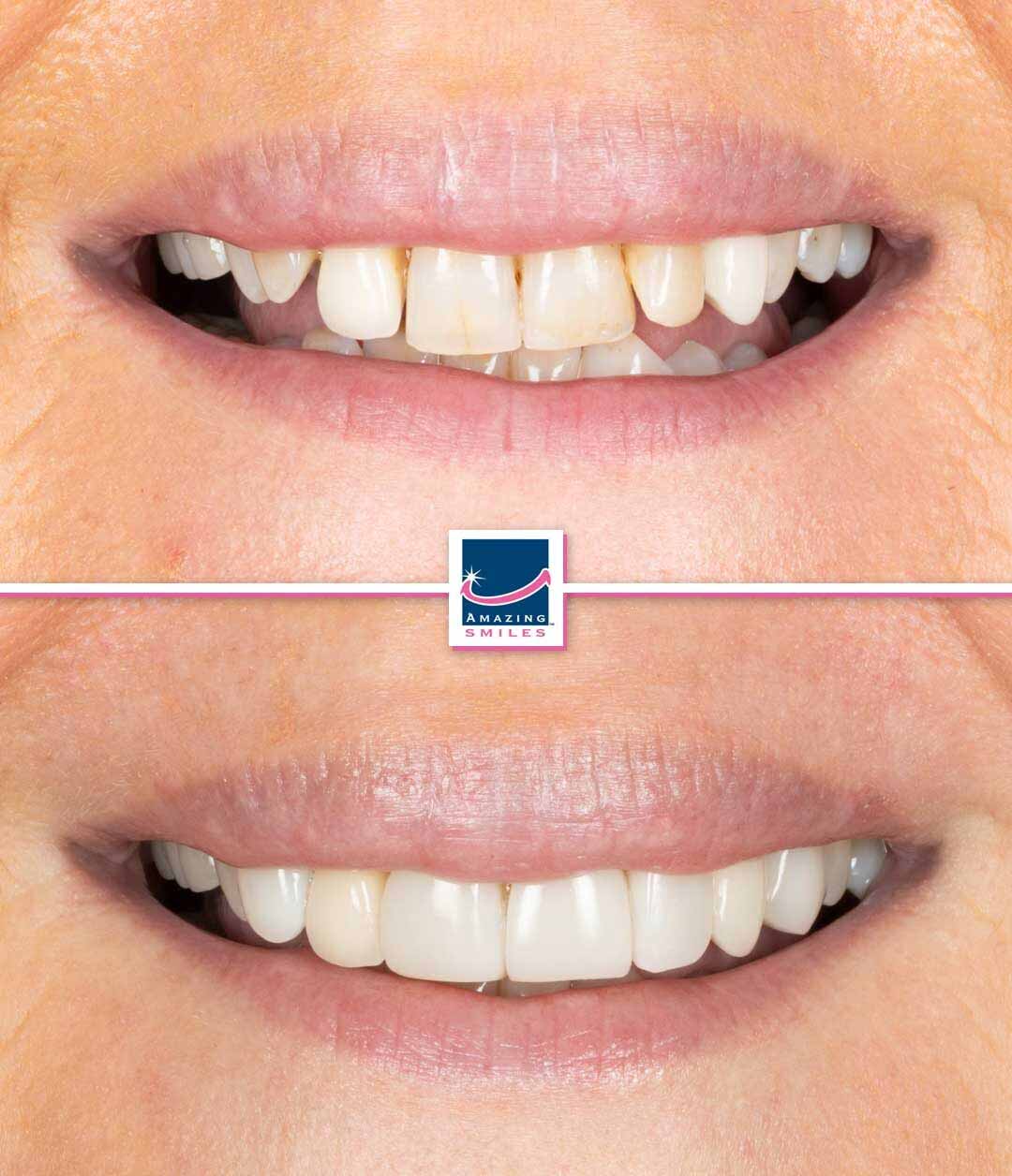 Dentist Bray Park - Amazing Smiles Composite veneers bray park