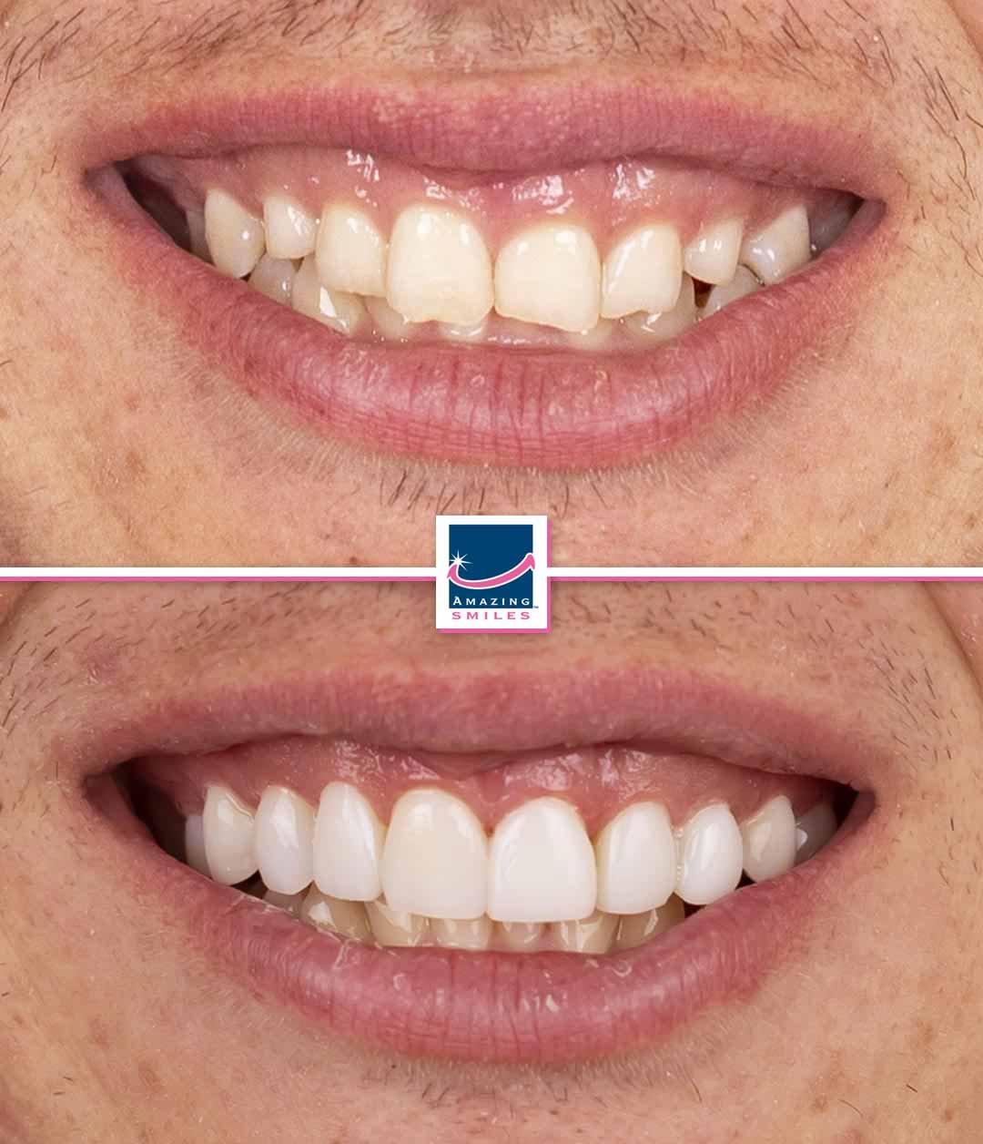 Composite veneers gold coast cosmetic dentist