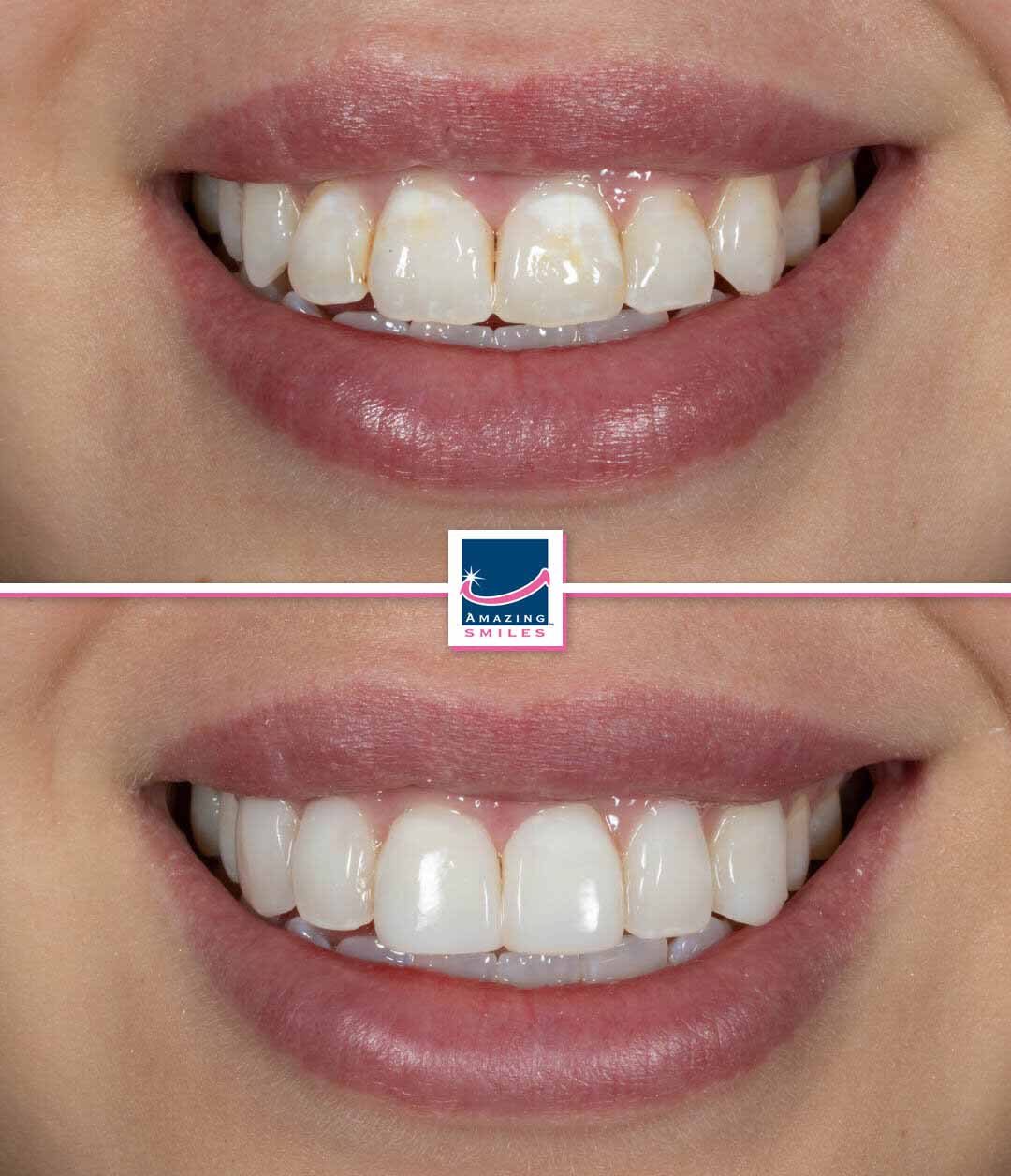 Composite Veneers - Amazing Smiles Composite veneers gold coast