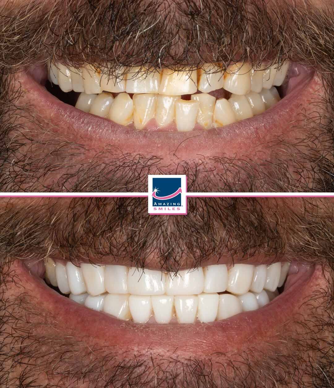 Dentist Jimboomba - Amazing Smiles Composite veneers jimboomba cosmetic dentist