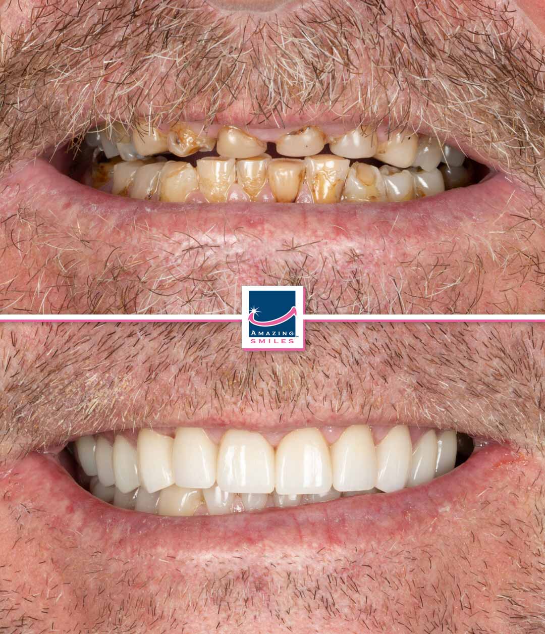 Dentist Logan - Amazing Smiles Cosmetic dentist for dentalcrowns logan