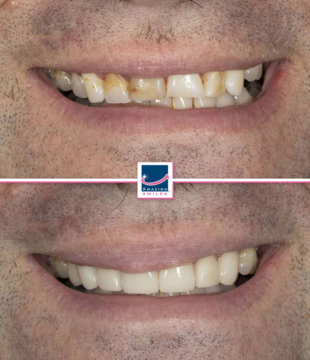 Dental crowns gold coast