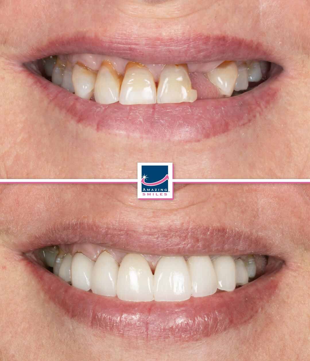 Cosmetic dentist to replace missing teeth