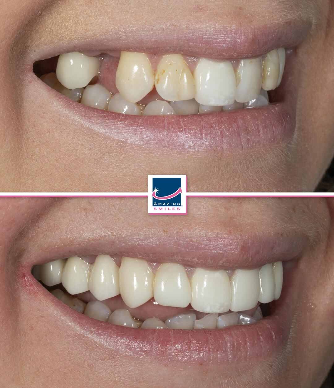 Dentist Bray Park - Amazing Smiles Dental implant dentist near me